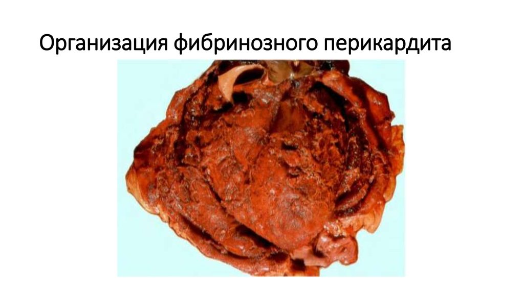Организация фибринозного перикардита
