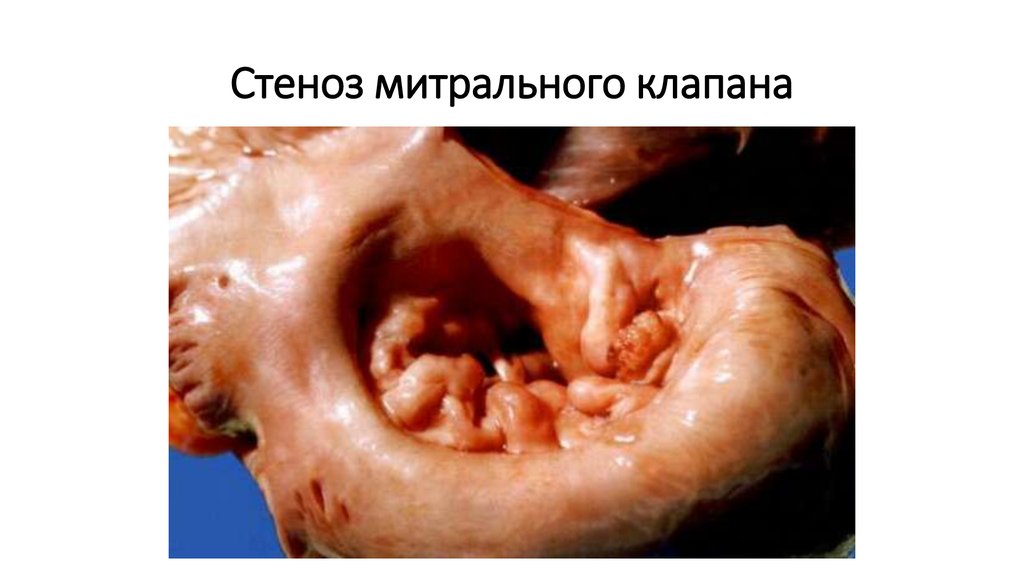 Стеноз митрального клапана