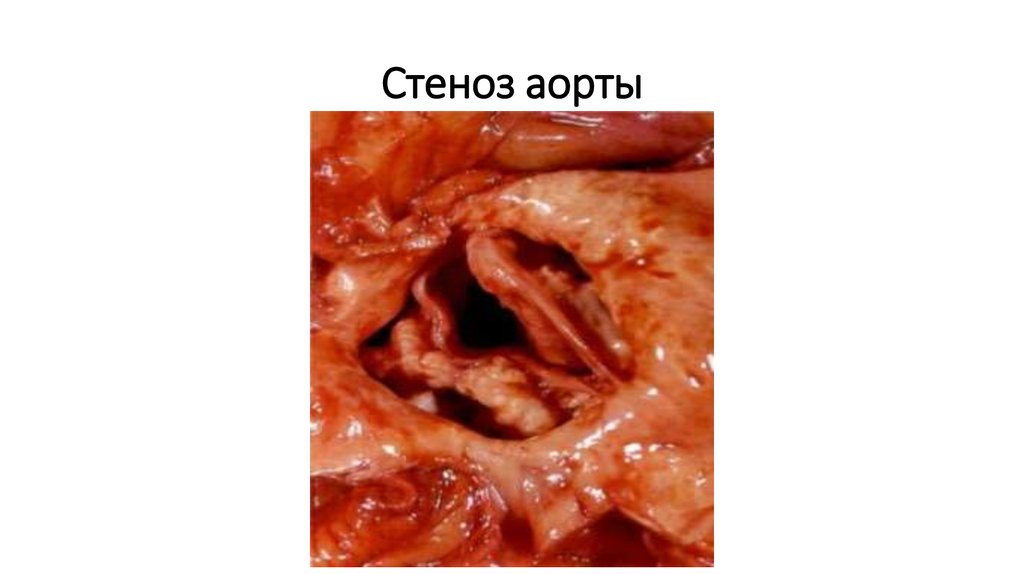 Стеноз аорты