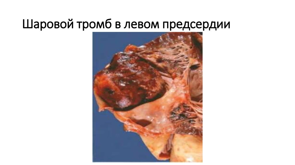 Шаровой тромб в левом предсердии