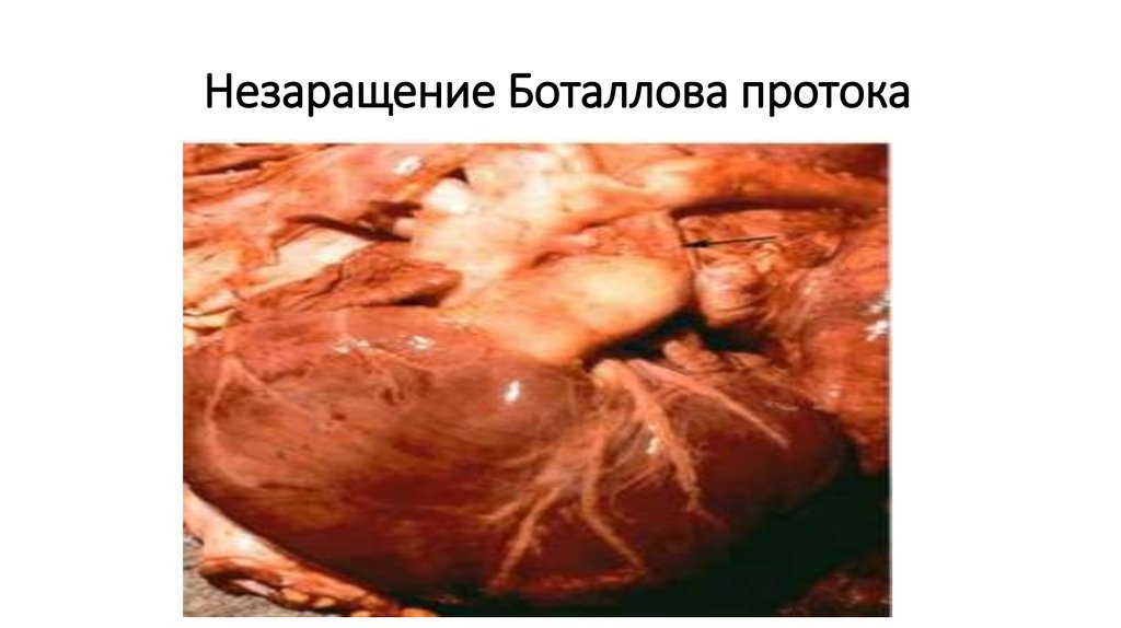 Незаращение Боталлова протока