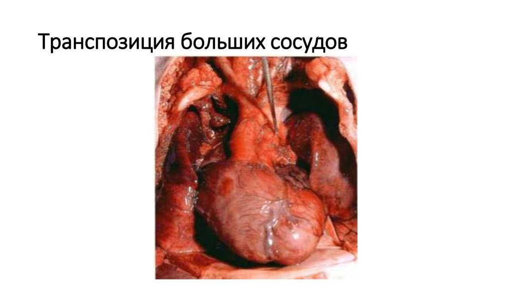 Транспозиция больших сосудов