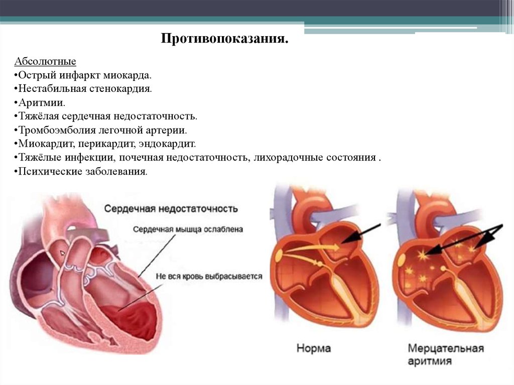 Миокардиальная сердечная недостаточность. Эндокардит миокардит перикардит. Миокардит сердечная недостаточность. Эндокардит миокардит сердечная недостаточность. Нестабильный инфаркт миокарда.
