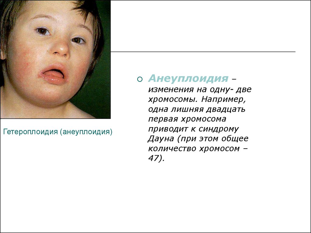 Синдром дауна лишняя хромосома. Синдром Дауна анеуплоидия. Гетероплоидия. Гетероплоидия у человека примеры.