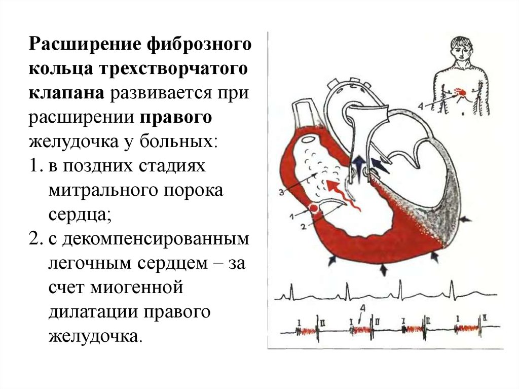 Желудочка сердца расширена. Расширение фиброзного кольца митрального клапана. Трикуспидальный клапан фиброзное кольцо норма. Фиброзное кольцо митрального клапана. Фиброзное кольцо митрального клапана норма.