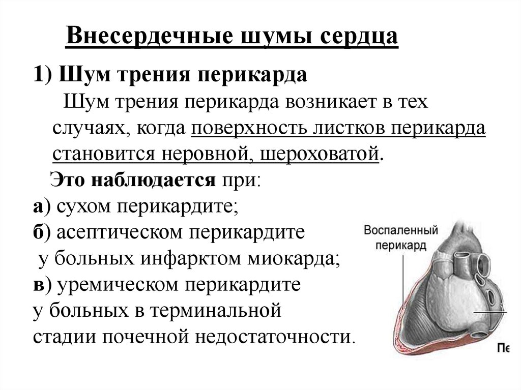 Шумы сердца пропедевтика презентация