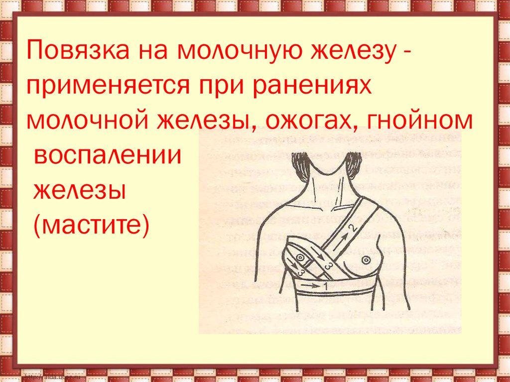 Повязка на молочную железу. Наложите бинтовую повязку на молочную железу.. Наложение повязки на молочную железу. Наложение повязки на молочную железу на статисте. Наложение повязки на молочную железу алгоритм.