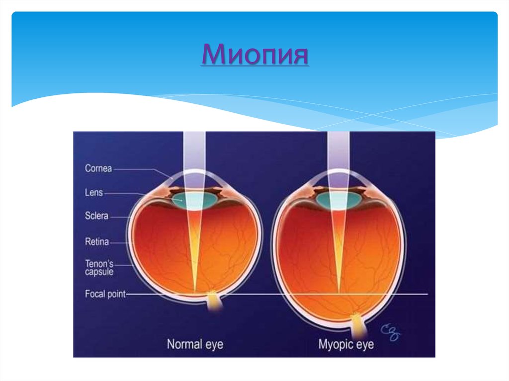 Миопия при беременности презентация