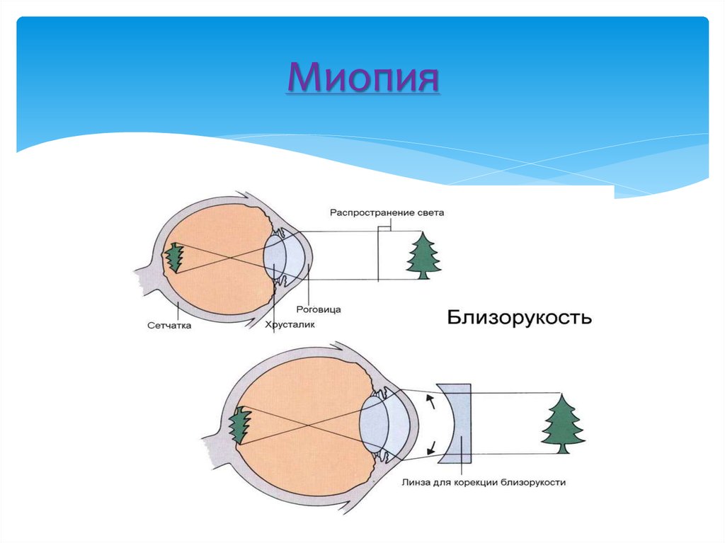 Миопия что это простыми словами. Близорукость миопия. Заболевания глаз близорукость. Мтопи.