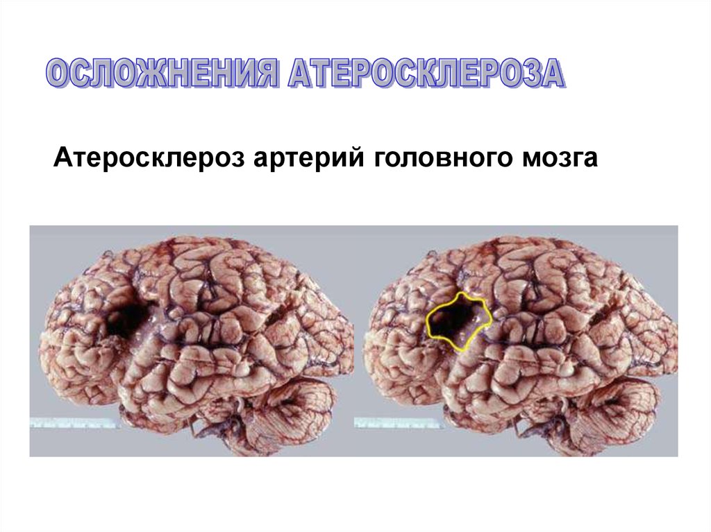 Атеросклероз церебральных сосудов симптомы. Атеросклероз сосудов головного мозга. Атеросклероз артерий головного мозга. Атеросклероз головного мозга осложнения. Атеросклеротическое поражение сосудов головного мозга.