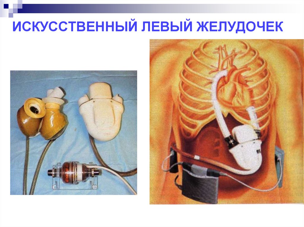 Сколько весит искусственный левый желудочек. Искусственный левый желудочек. Искусственный левый желудочек сердца. Имплантация искусственного желудочка сердца. Имплантация искусственного левого желудочка.
