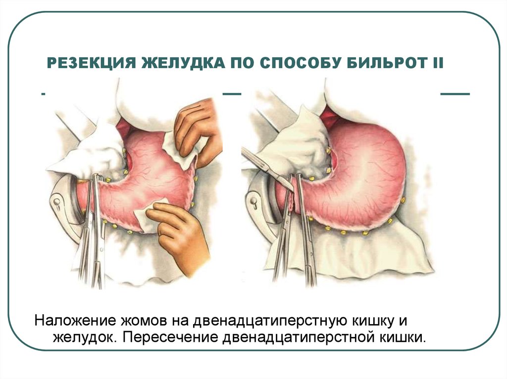 Резекция желудка фото до и после желудка