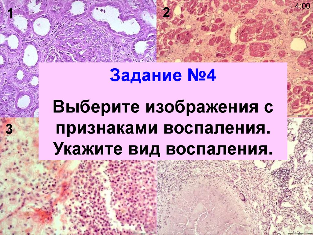 Биопсия патологическая анатомия. Виды воспаления патанатомия. Мускатная печень патологическая анатомия. Виды воспаления патологическая анатомия. Воспаление патанатомия презентация.