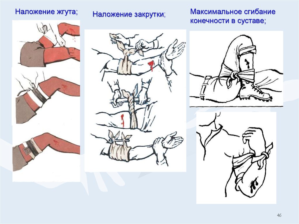 Максимальное наложение. Наложение жгута закрутки. Наложение жгута или закрутки. Наложение жгута закрутки на верхнюю конечность техника. Жгут закрутка наложение алгоритм.