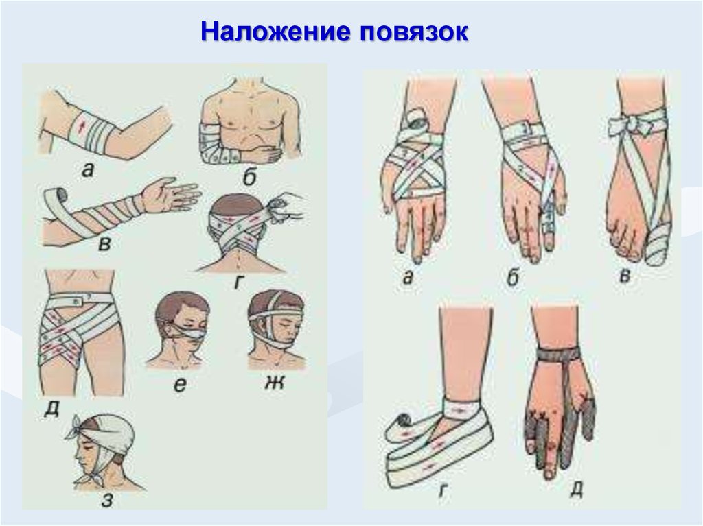 Рисунки наложения повязок