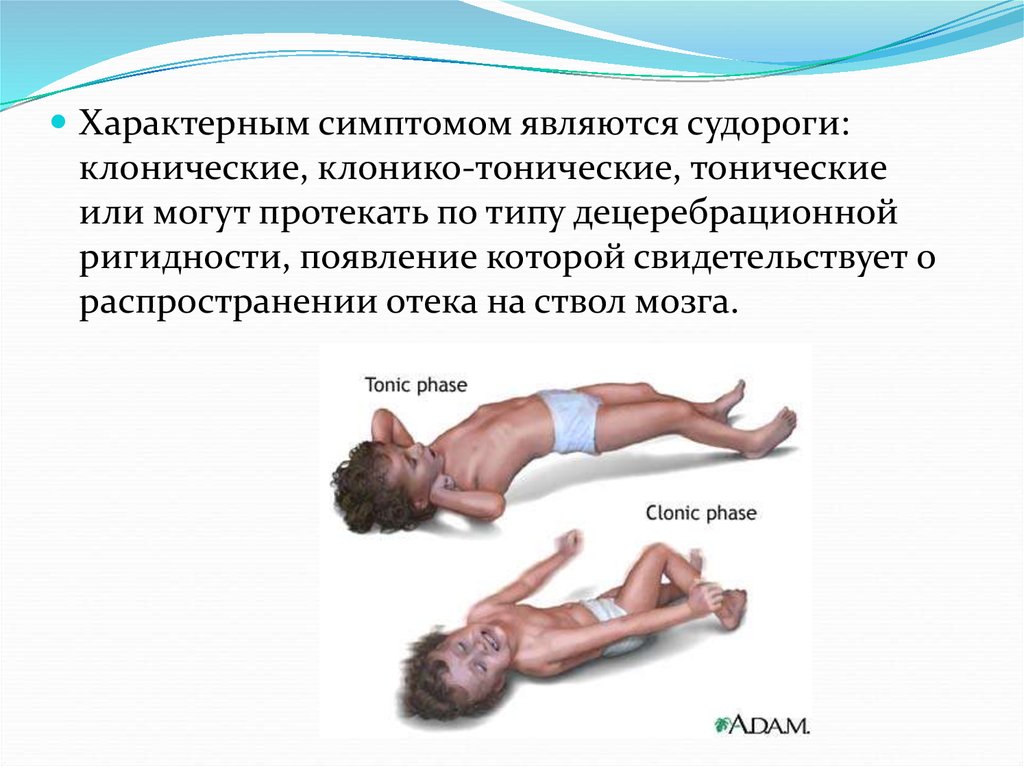 Течение судорог. Тонические и тонико клонические судороги. Тонические и клонические судороги у детей. Тонико-клонические судороги причины. Клонические судороги подергивания.
