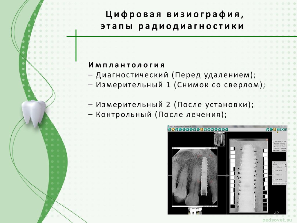 Перед удалением. Схема визиографии. Визиография с калибровкой. Алгоритм визиографии. Кратко излучения дает визиография.