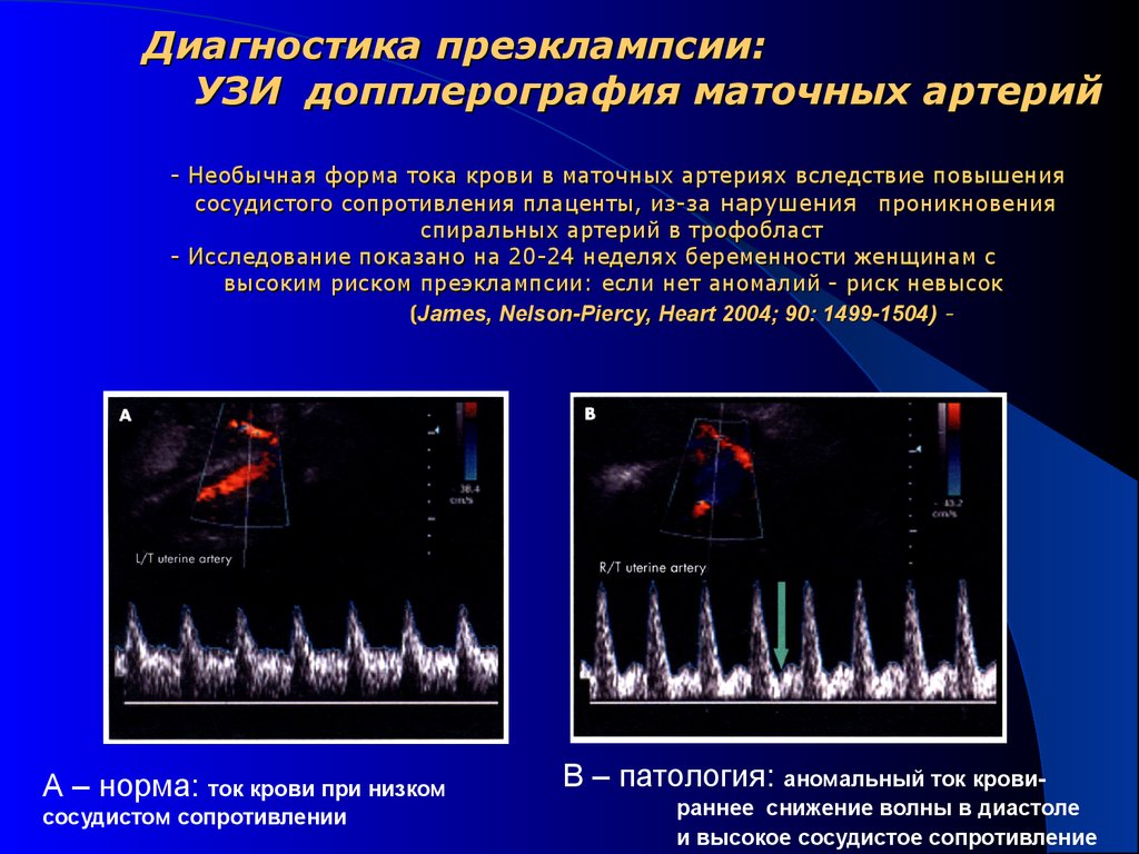 Доплер 2. УЗДГ – ультразвуковая допплерография сосудов. Ультразвуковая допплерография аорты. Допплерография маточных артерий. УЗИ допплерометрия маточных артерий.