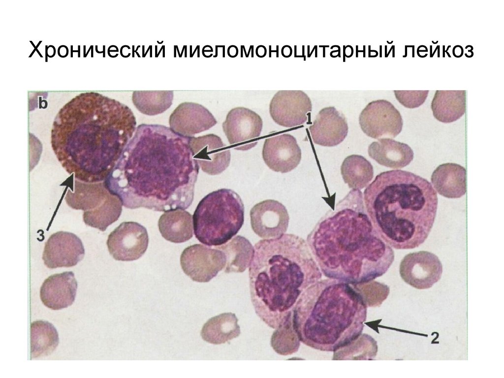 Лейкоз картина крови