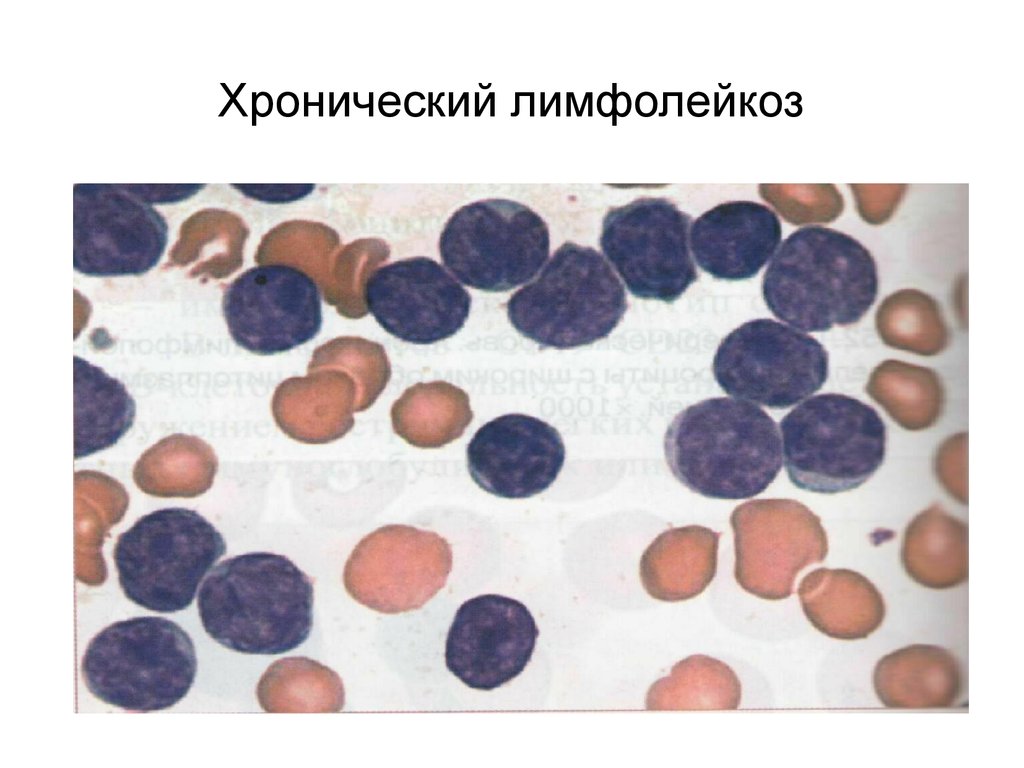 Лимфолейкоз код. Волосатоклеточный лейкоз картина крови. Хронич лимфобластный лейкоз. Лимфоцитарный лейкоз острый и хронический. Хронический лимфоидный лейкоз.