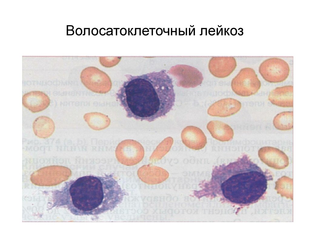 Созылмалы лимфолейкоз презентация