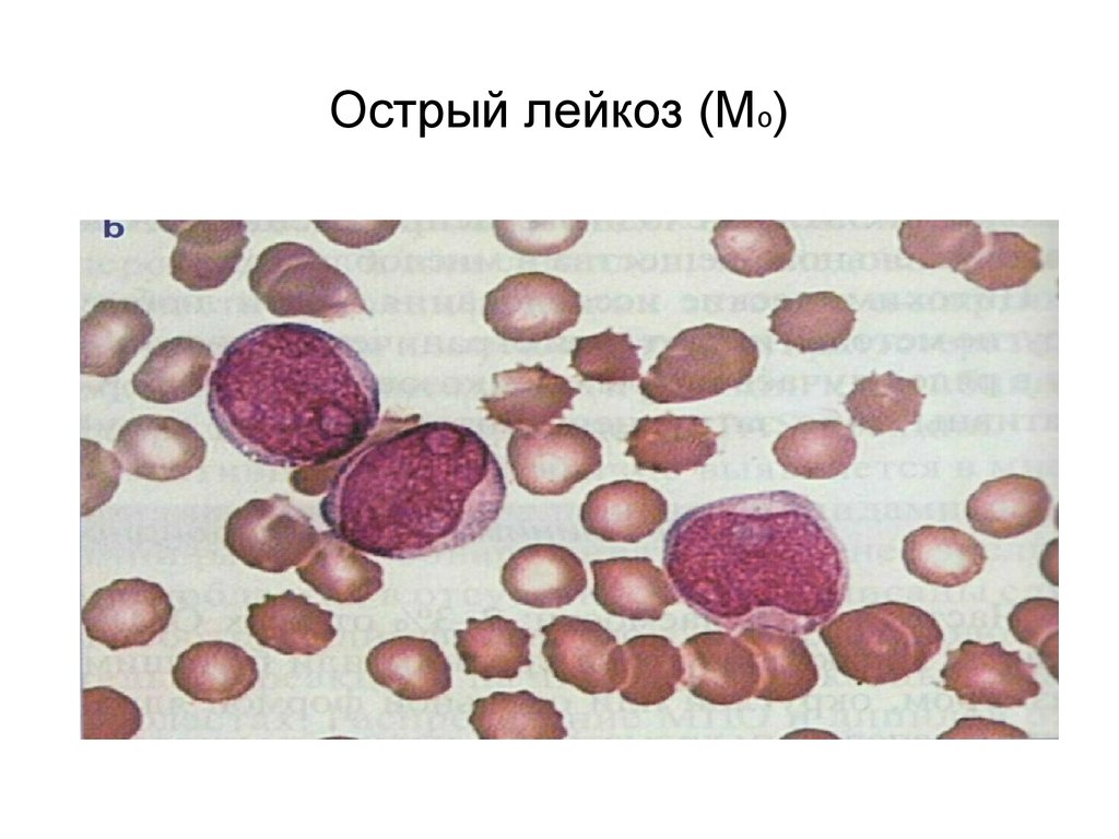 Острый миелолейкоз презентация