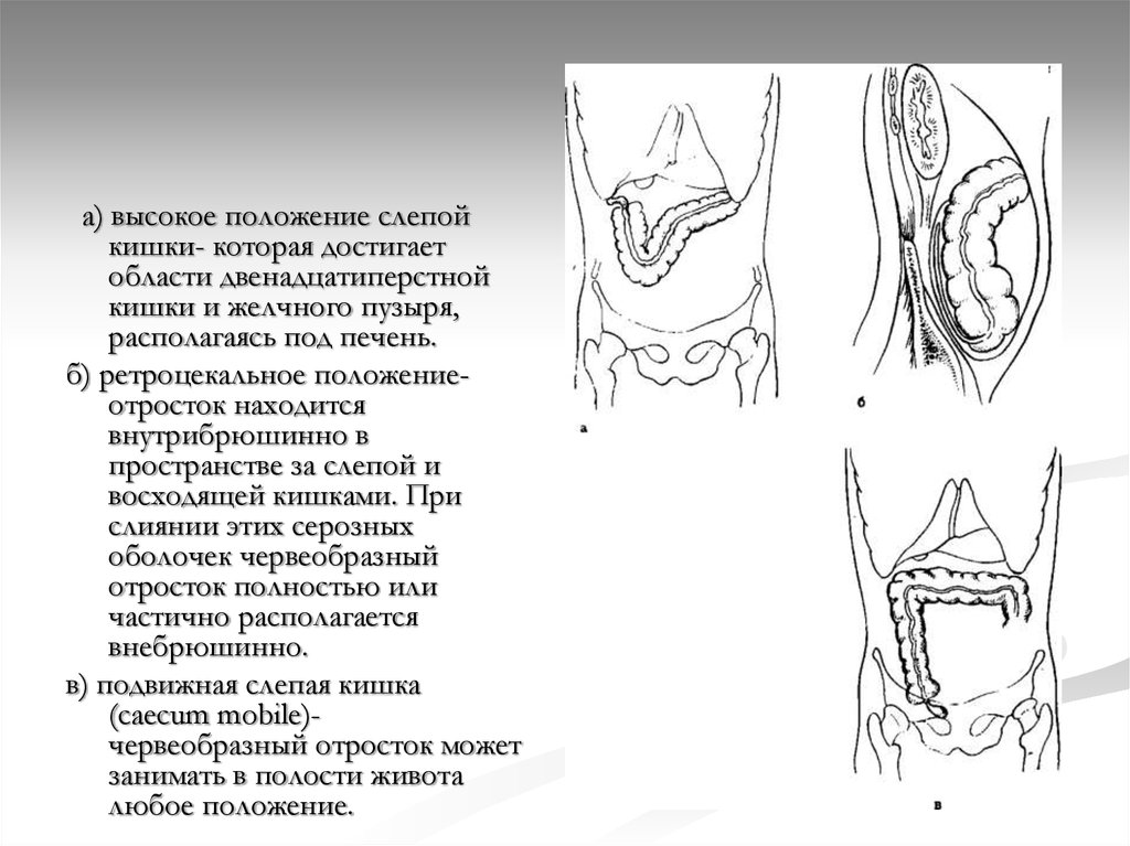 Высокое положение. Высокое расположение слепой кишки. Низкое расположение слепой кишки. Типичные положения слепой кишки. Подпеченочное расположение расположения слепой кишки.