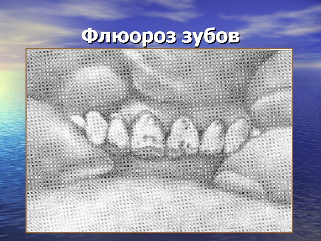 Зубов без воды. Меловидно крапчатый флюороз. Флюороз зубов пятнистая форма. Флюороз зубов (эндемический флюороз зубов) —.