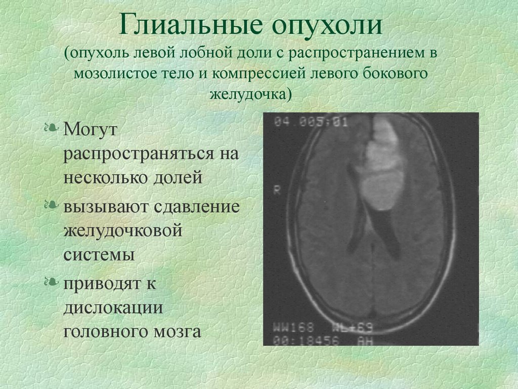 Глиальная опухоль головного. Опухоли боковых желудочков головного мозга. Объемное образование боковых желудочков головного мозга. Опухоль левой лобной доли. Опухоль лобной доли головного мозга.