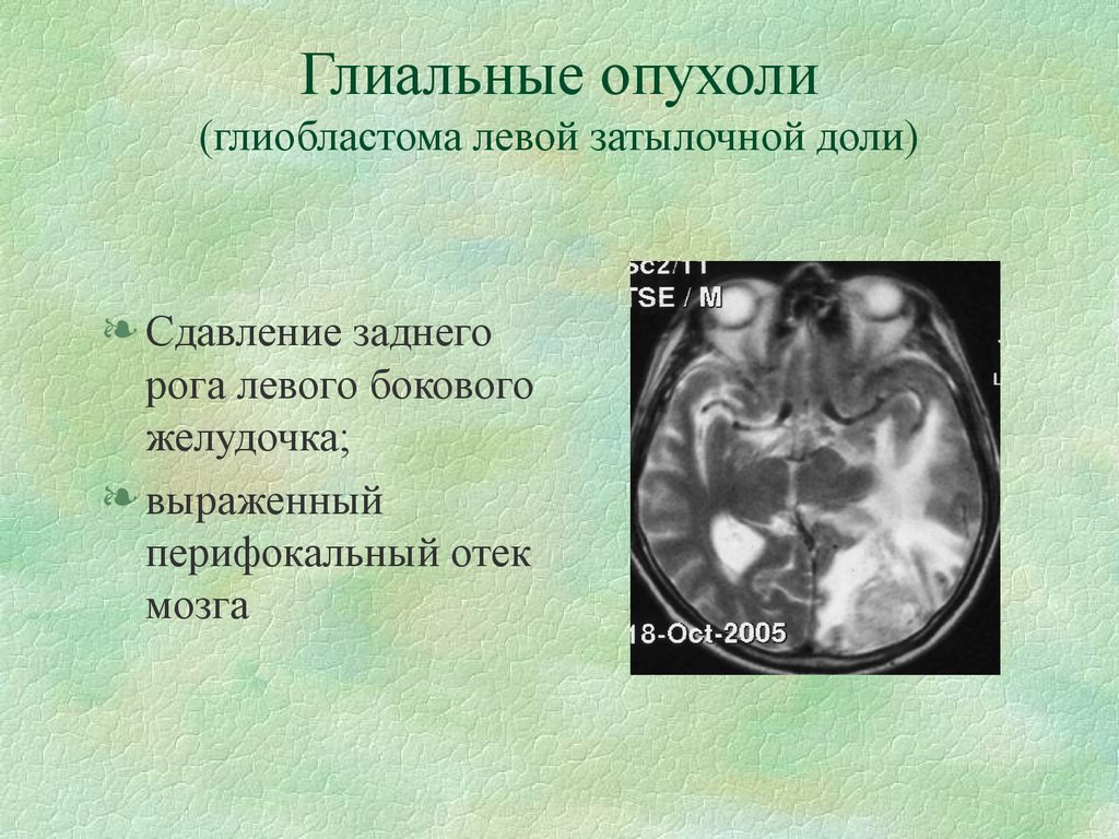 Глиальная опухоль головного. Глиальные опухоли мозга. Глиобластома затылочной доли. Глиальные опухоли головного мозга классификация.