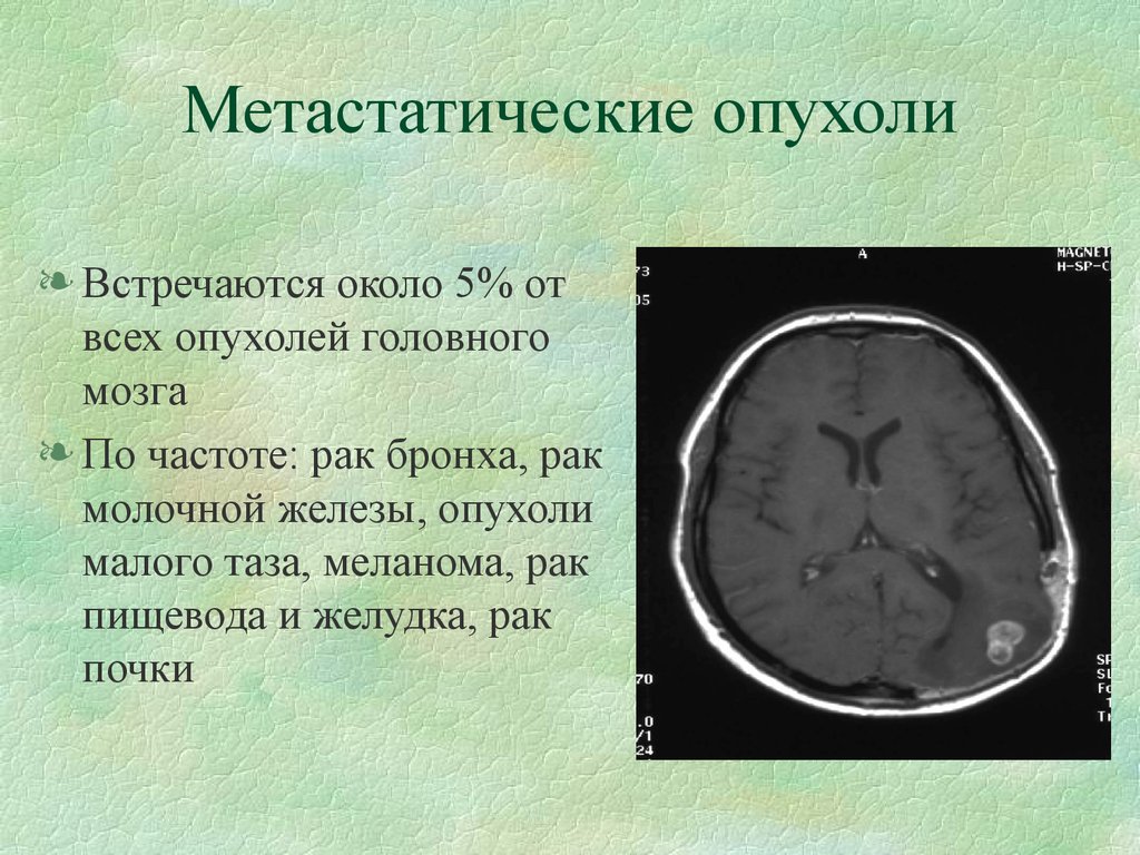 Рак мозга сколько стадий. Метастазы меланомы в головной мозг мрт. Метастатические опухоли головного мозга. Опухоли головного мозга презентация. Отек головного мозга презентация.