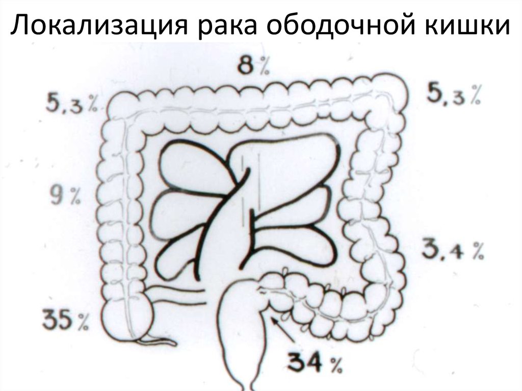Локализация рака ободочной кишки