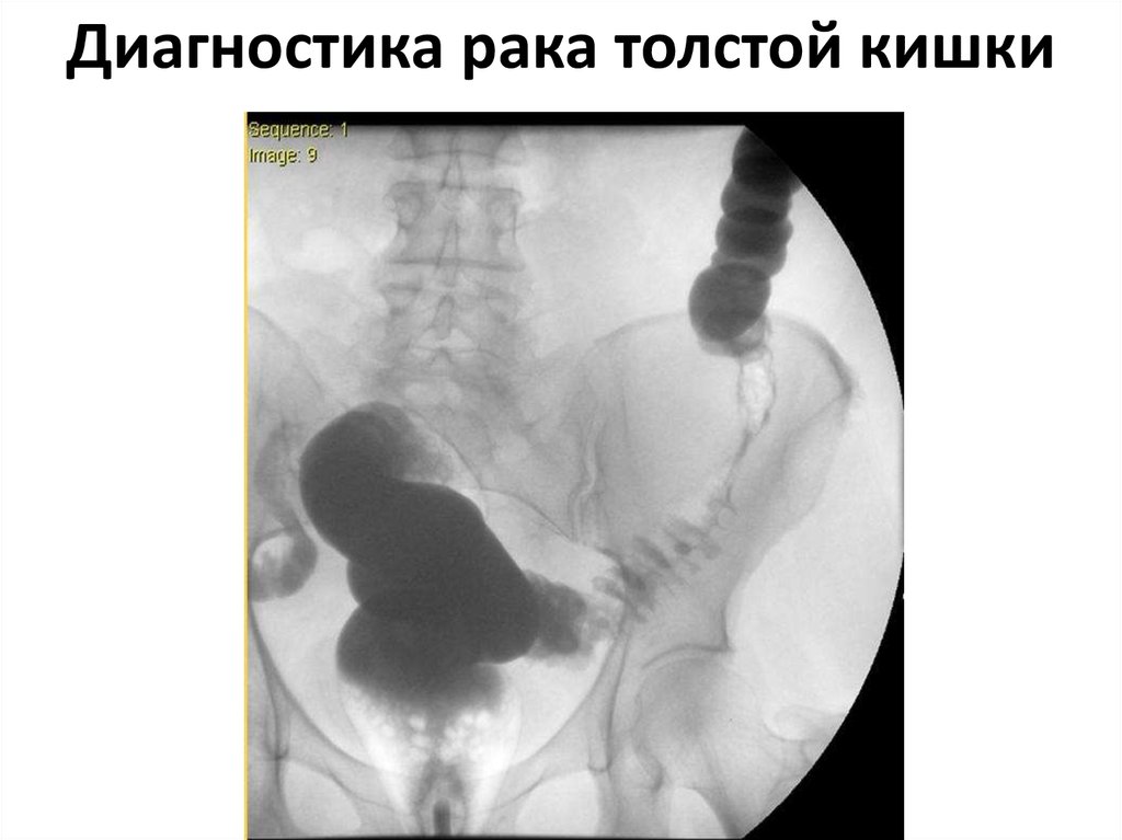 Диагностика рака толстой кишки