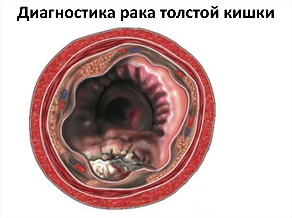 Диагностика рака толстой кишки
