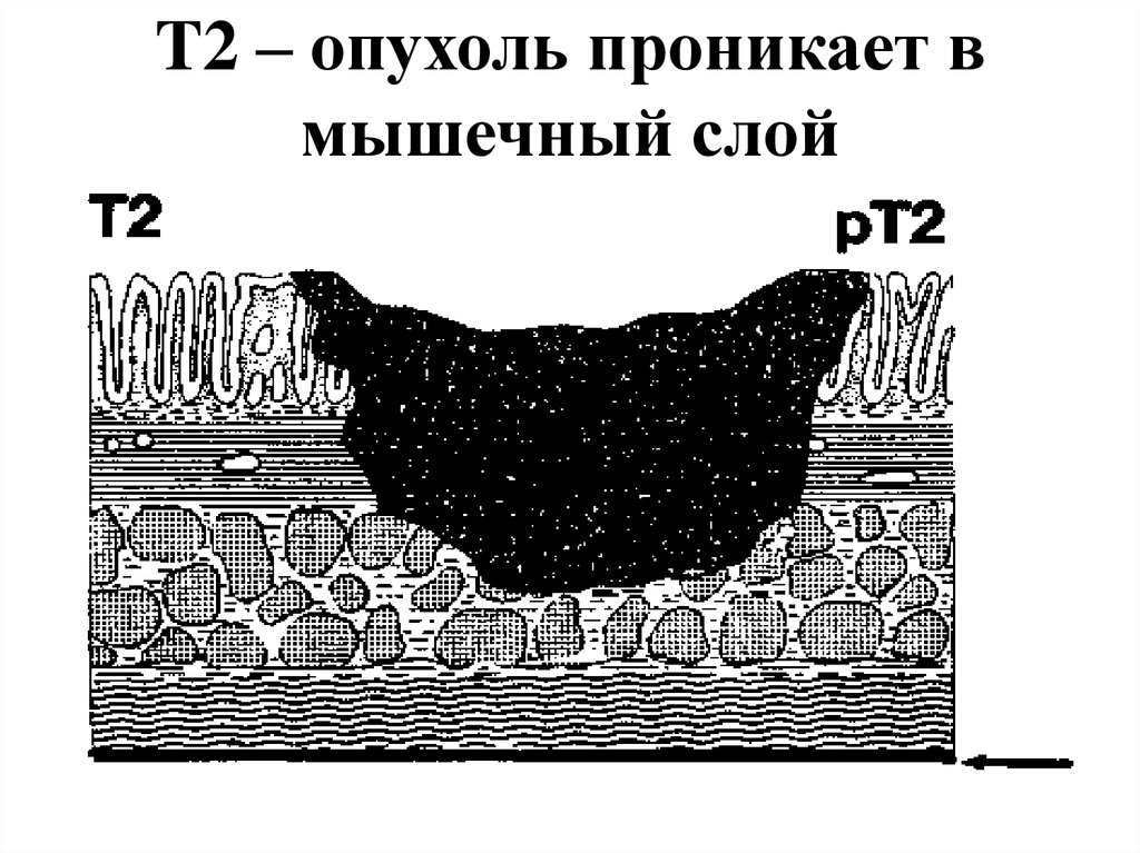 T2 – опухоль проникает в мышечный слой