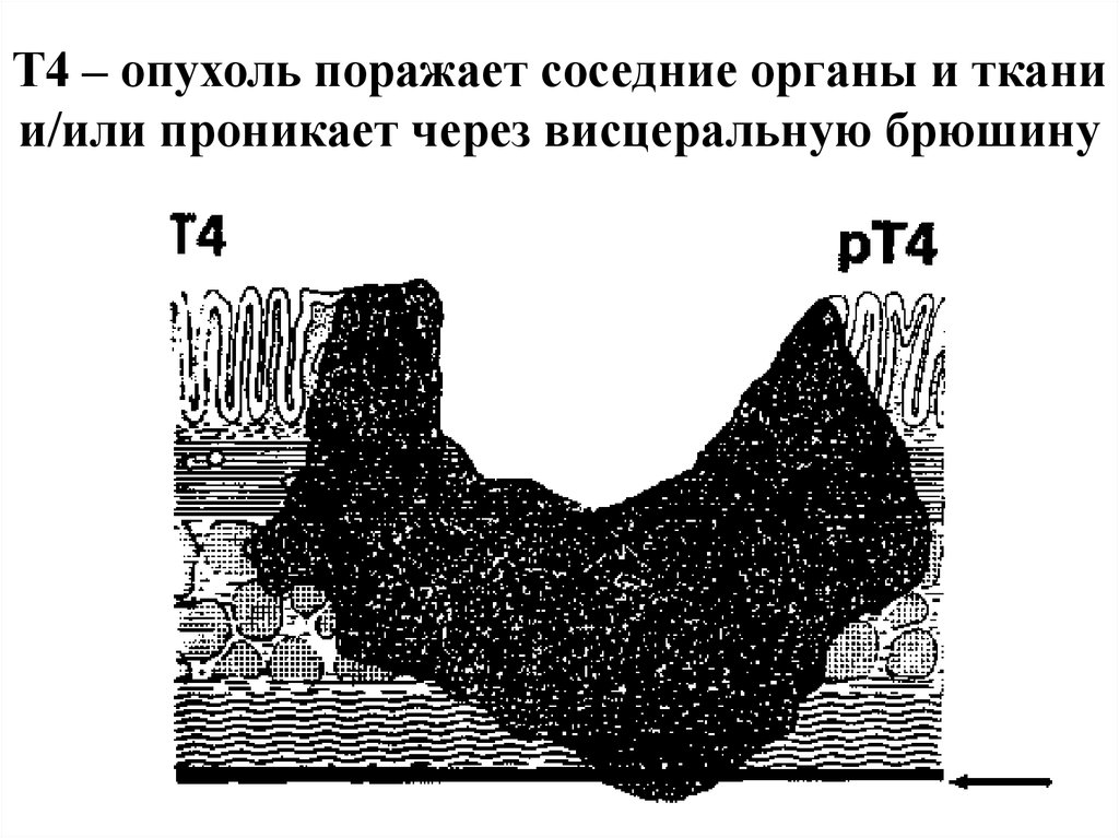 Т4 – опухоль поражает соседние органы и ткани и/или проникает через висцеральную брюшину