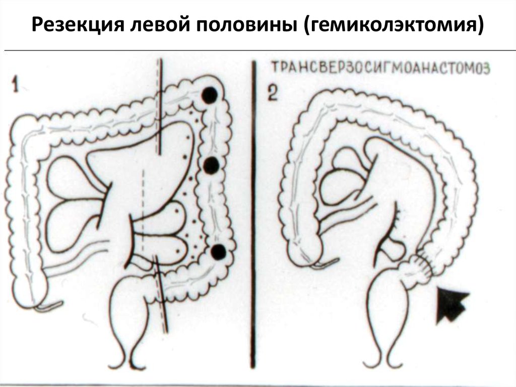 Резекция левой половины (гемиколэктомия)