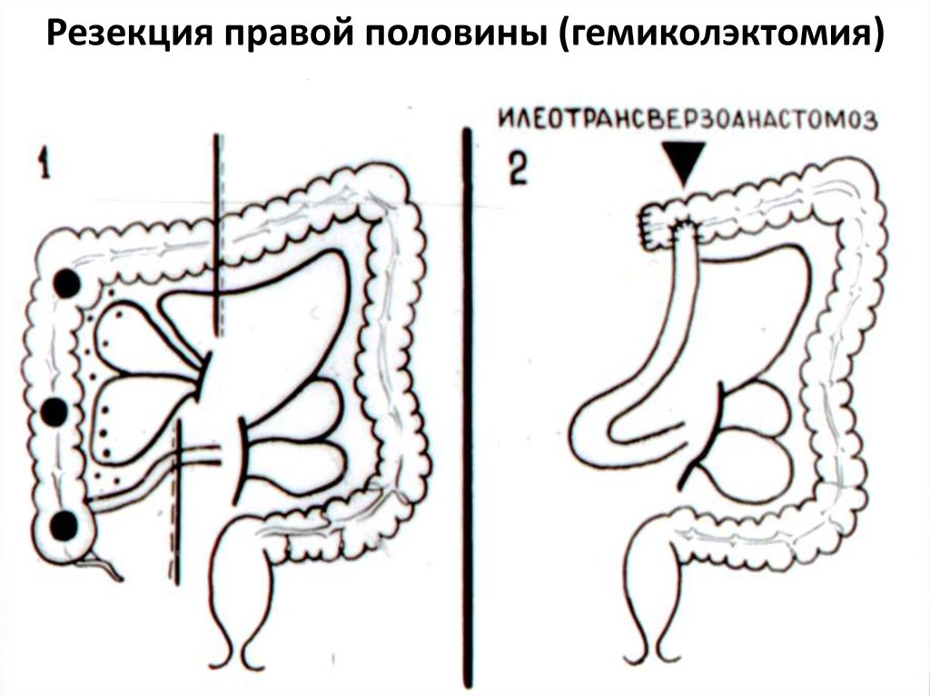 Гемиколэктомия это