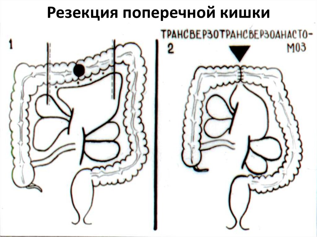 Кишки рецепт с фото пошагово. Резекция поперечно-ободочной кишки. Резекция поперечной ободочной. Резекция ободочной кишки. Резекция поперечной ободочной кишки оментэктомия.