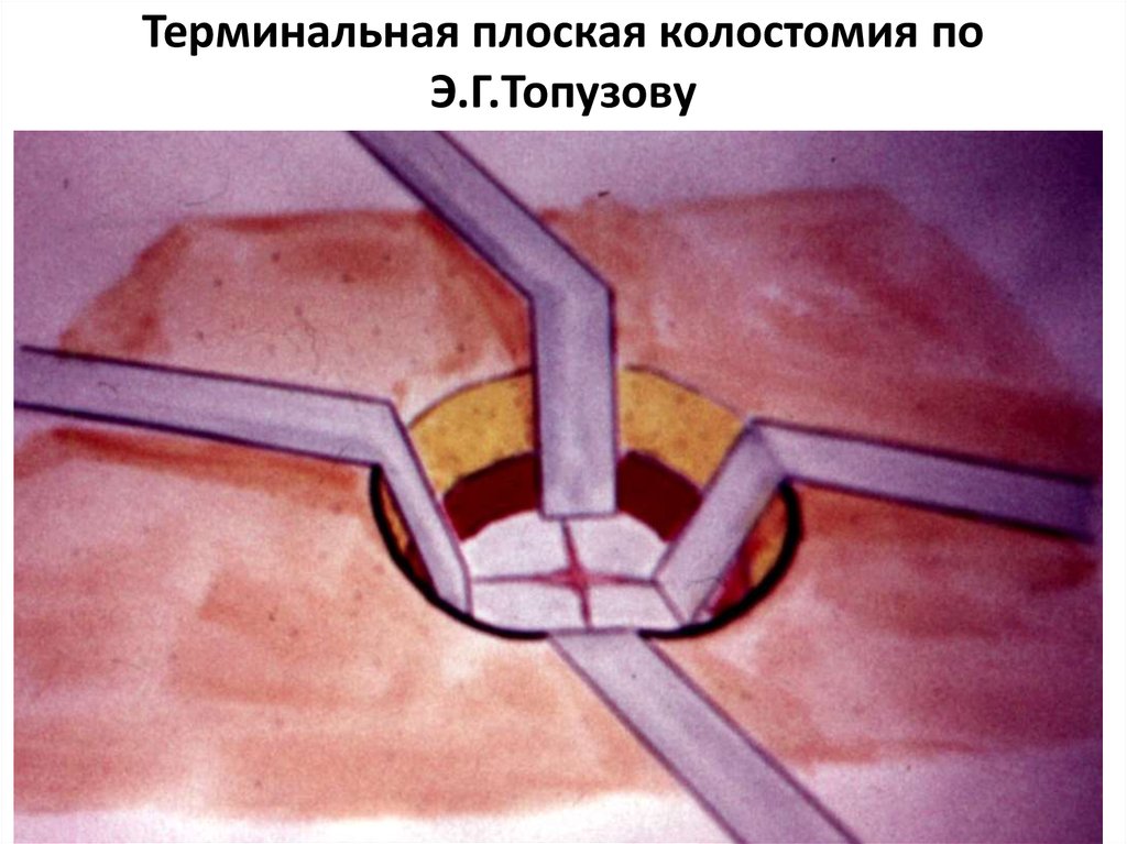Терминальная плоская колостомия по Э.Г.Топузову