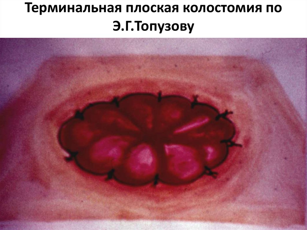 Терминальная плоская колостомия по Э.Г.Топузову
