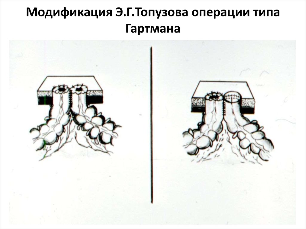 Схема операция гартмана