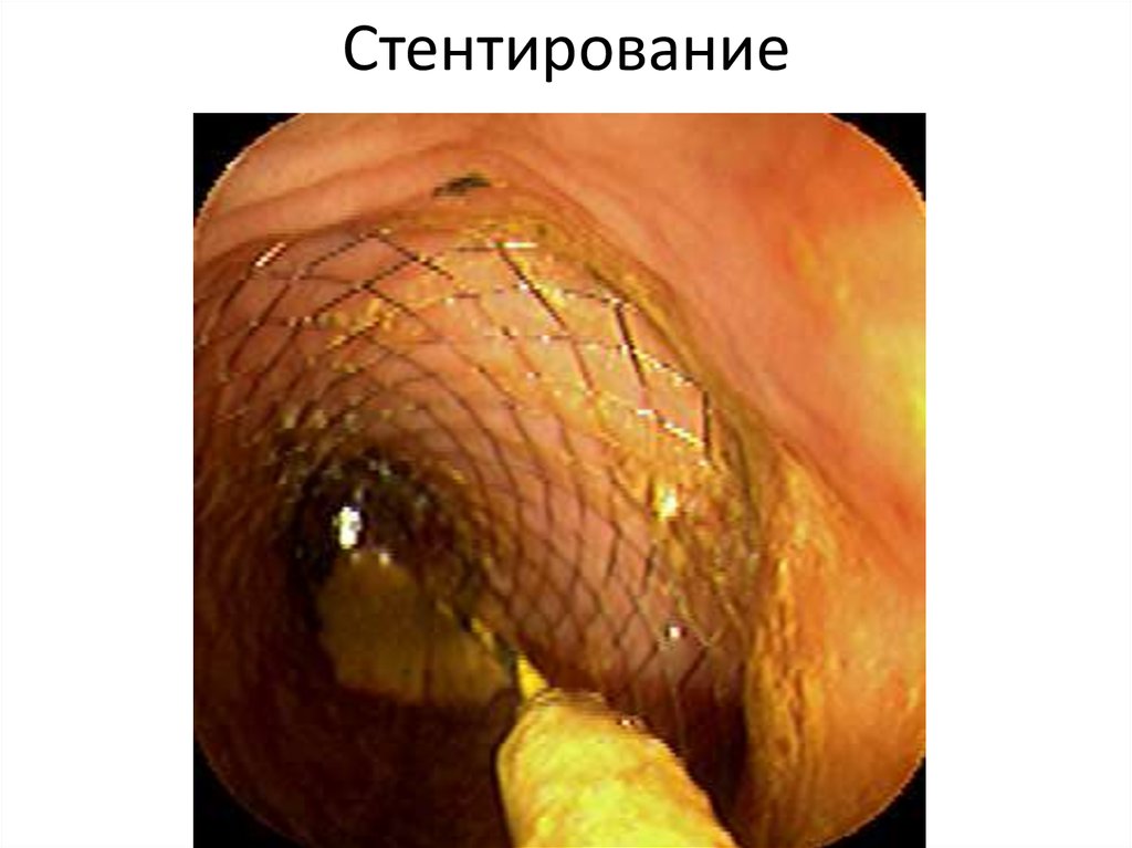 Стентирование