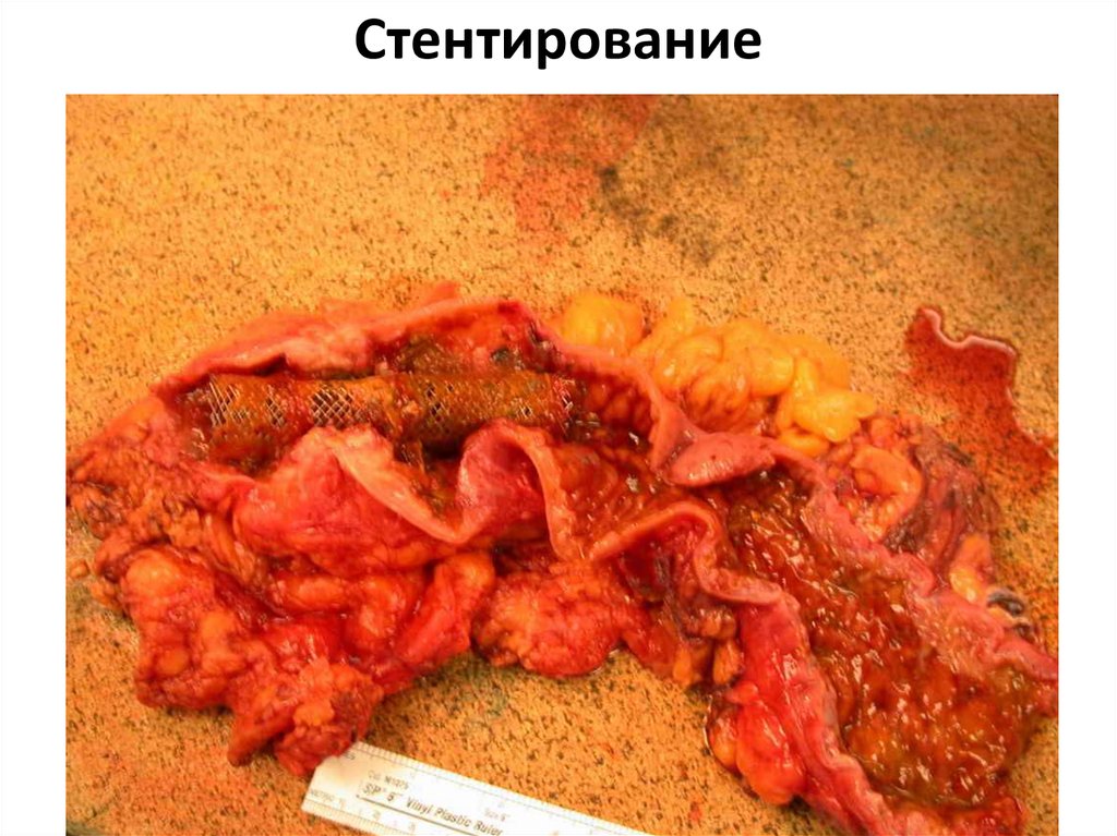 Стентирование