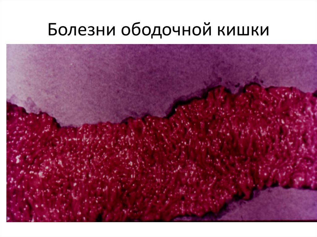 Болезни ободочной кишки