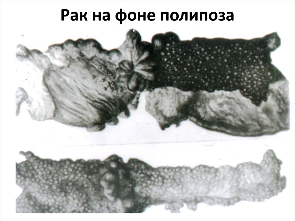 Рак на фоне полипоза