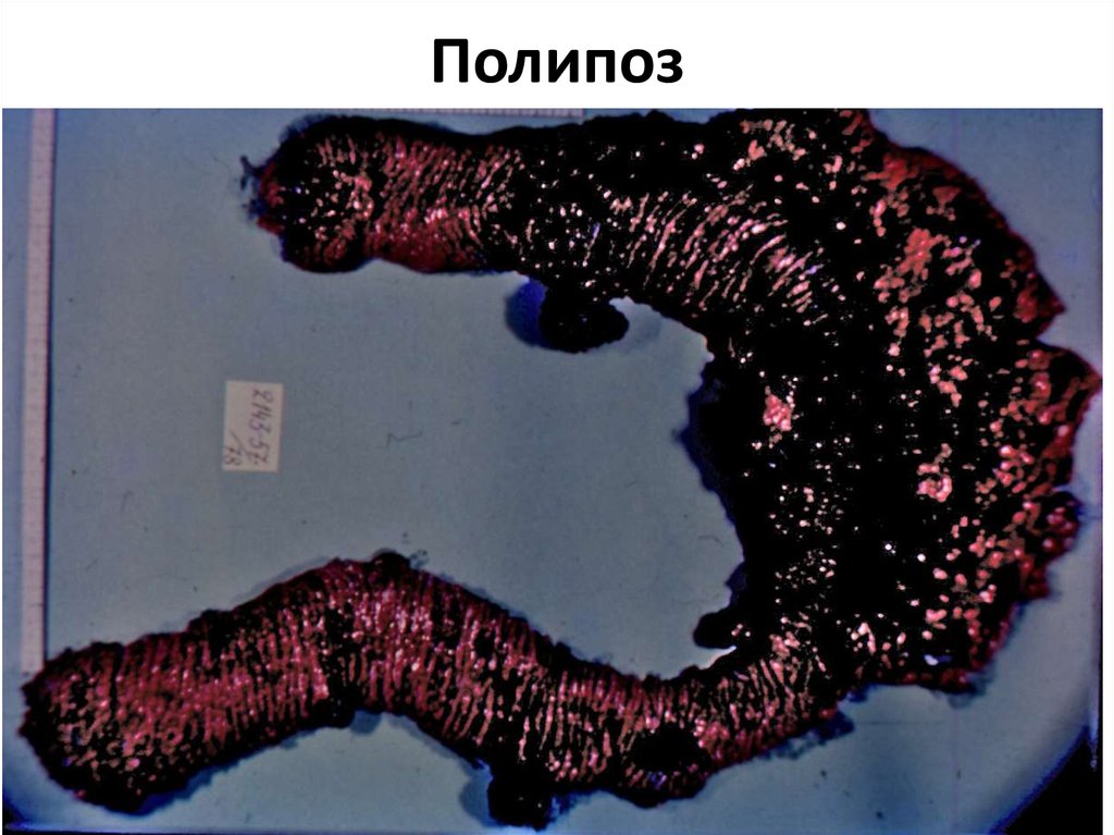 Полипоз