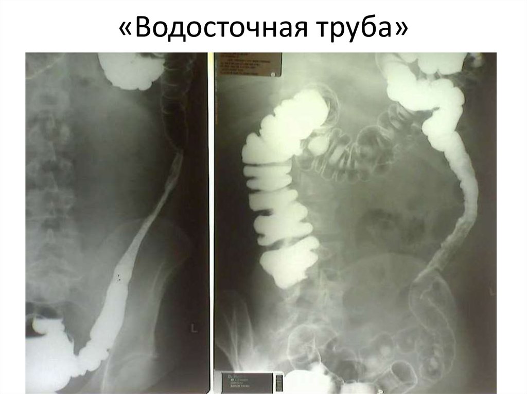 «Водосточная труба»