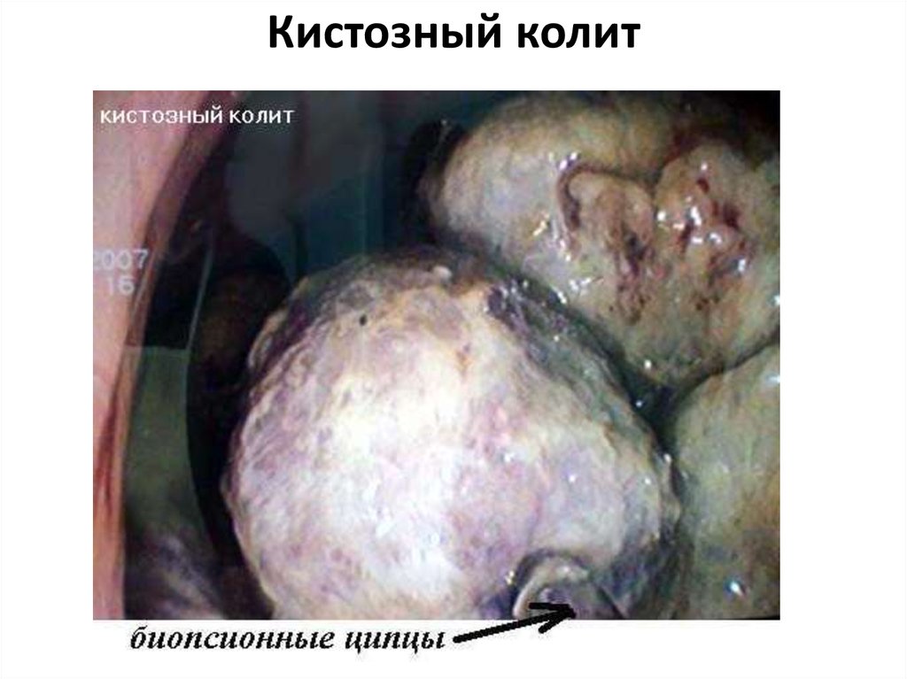 Кистозный колит