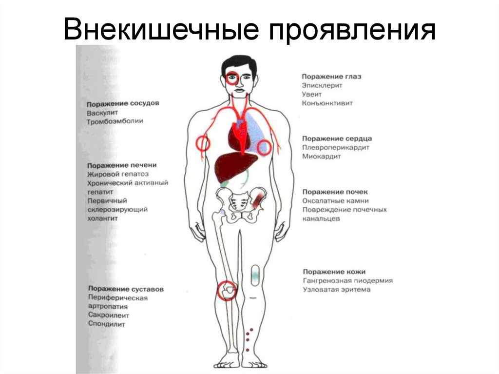 Симптомы болезни. Внекишечные проявления болезни крона. Внекишечные осложнения болезни крона. Внекишечные проявления болезни крона таблица. Кишечные осложнения болезни крона.